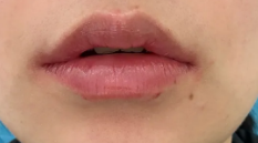 让肌肤突破年龄封印 激光把皱纹一网打尽