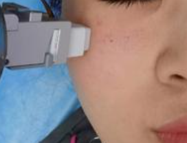 ​聊聊对“黄金射频微针”的爱与恨