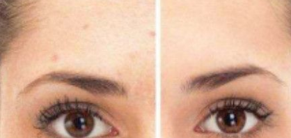 激光点痣能不能彻底解决顽固的色素症