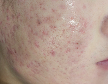 战痘“针”有效——单针射频