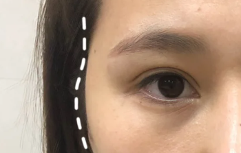 填充太阳穴脸颊快4年，不馒化怎么做到的