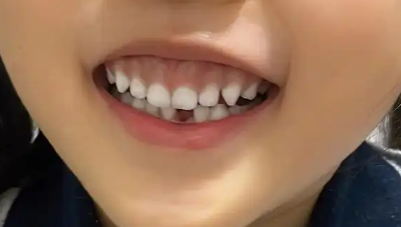 露龈笑也可以用玻尿酸来解决吗