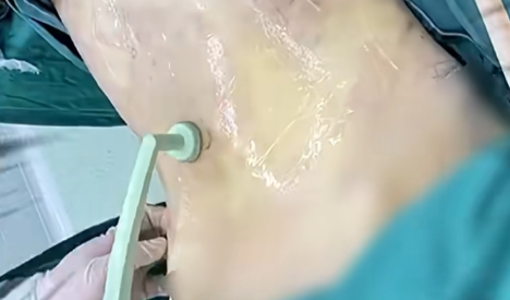 躺着就能瘦？酷塑冻掉您的脂肪