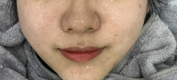 调Q激光（白瓷娃娃）百科