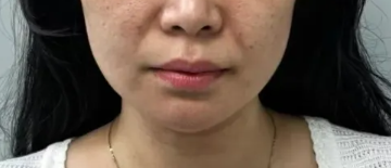 胶原蛋白面部种植 —— 无痛无创重塑年轻...