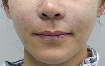 如何让通过注射实现韧带提升