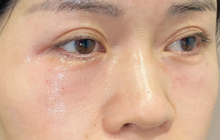 泪沟填充选玻尿酸还是胶原蛋白