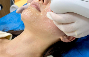 双11做光子嫩肤划算吗