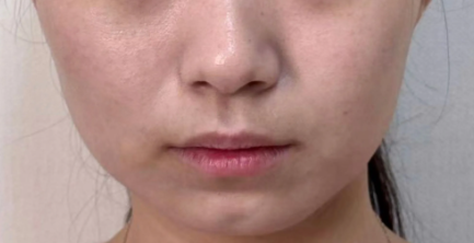 玻尿酸填充=脸僵？你确定自己真的“整”明...