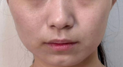 玻尿酸填充=脸僵？你确定自己真的“整”明...