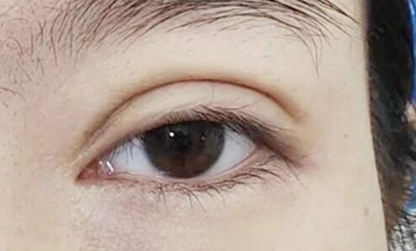 双眼皮术后宽窄不对称原因分析