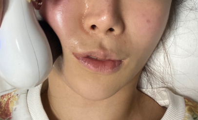 科学认识热拉提：它的“热”如何作用于你的皮肤