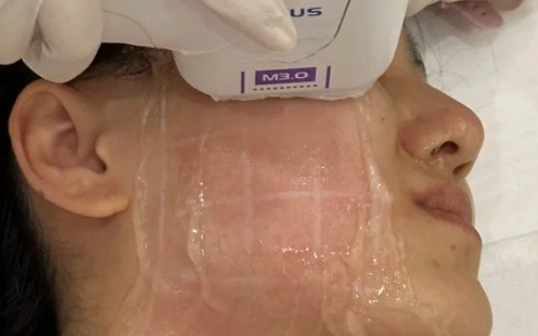 超声炮的功效和作用及副作用，全面解析与安全指南