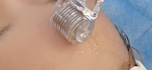 什么是中胚层疗法？效果如何？是不是智商税