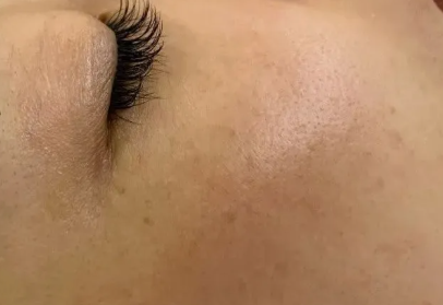 Alma飞顿牛奶光简介+功效+注意事项