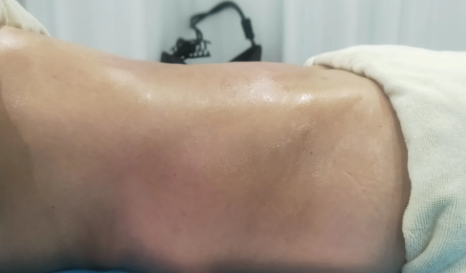 超声闪瘦，新一代超声溶脂技术，让你瘦得更...