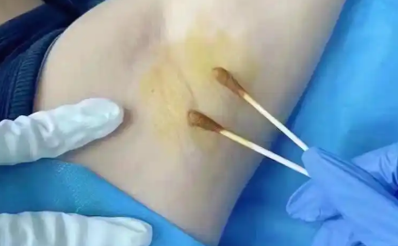 更年期女性潮热多汗，怎么破？微创注射一针改善