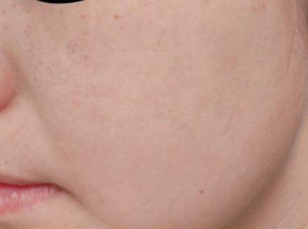 塑造“白瓷娃娃”的净肤镭射你了解多少