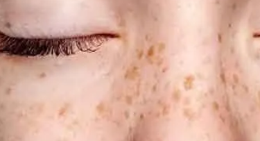 表层一颗斑，底层一窝斑 C10祛斑连根净扫更科学