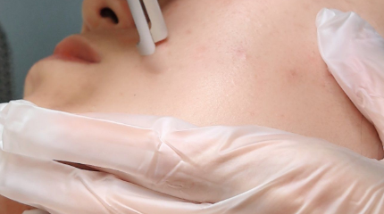 告别暗沉粗毛孔！「1064激光净肤」到底是什么神仙项目