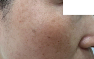 做完E光祛斑必须要注意的2点