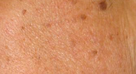 别让“老年斑”影响了您的容颜 脂溢性角化病（SK）的“扫斑”全攻略