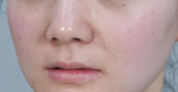 面部年轻化手术的适应症与效果