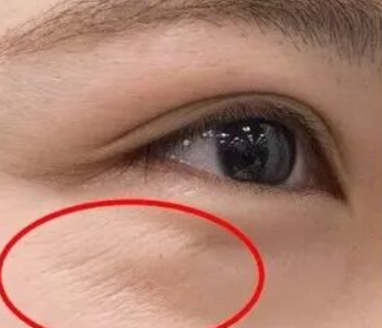 注射去鱼尾纹，了解它的真面目