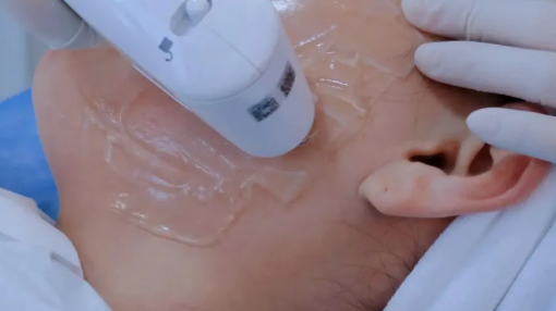 抗衰天花板超声炮为什么值得做