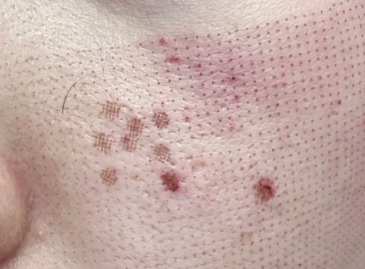 如何才能实现冻龄和逆龄？逆龄神器——科英点阵激光