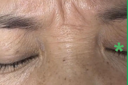 别让鼻背纹出卖了你的年龄