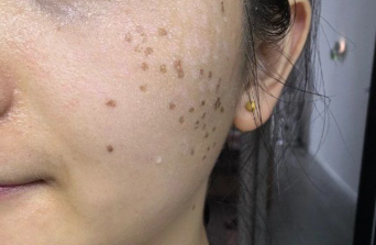 皮秒激光色斑、纹身的“精准打击手”，这些知识点要记牢