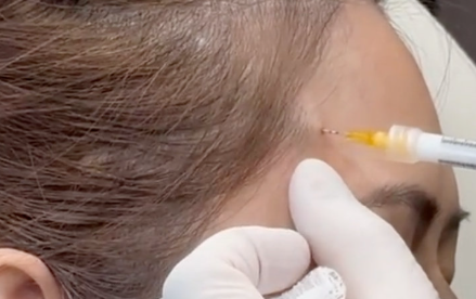 怕“馒化”？3分钟揭秘面部提升注射：靠韧带点位实现自然年轻