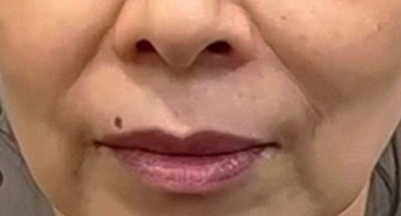 改善那些“衰老”的痕迹，哪些医美项目更适...