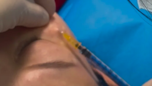 整形医生都在做的抗衰项目②——除皱针