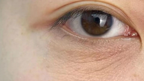 眼周细纹抗衰秘籍，射频抗衰怎么选