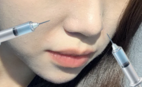 法令纹深还伴随苹果肌下垂，能通过胶原蛋白注射改善吗？会不会越填越僵