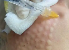 械三水光怎么选？可注射水光全攻略