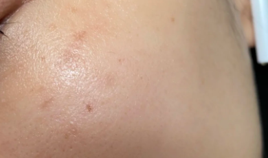 什么是“黑科技”皮秒激光