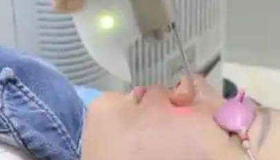 Fotona4Dpro治疗后注意事项