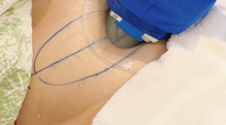 黑金超玛吉：无创超声溶脂，精准告别局部顽...